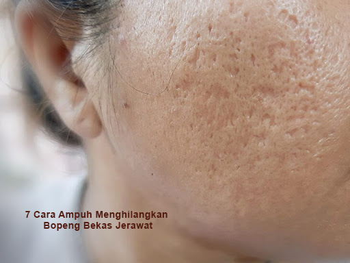7 Cara Ampuh Menghilangkan Bopeng Bekas Jerawat